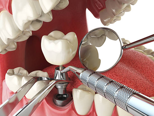 Best Emergency Root Canal Treatment in San Diego, CA